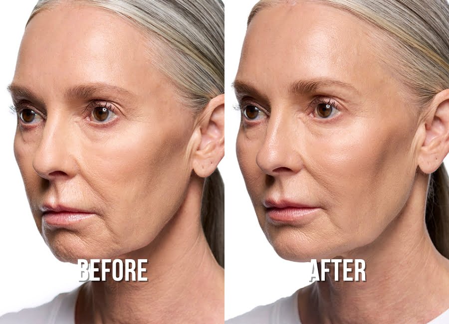 cheeks-before-after-1-img