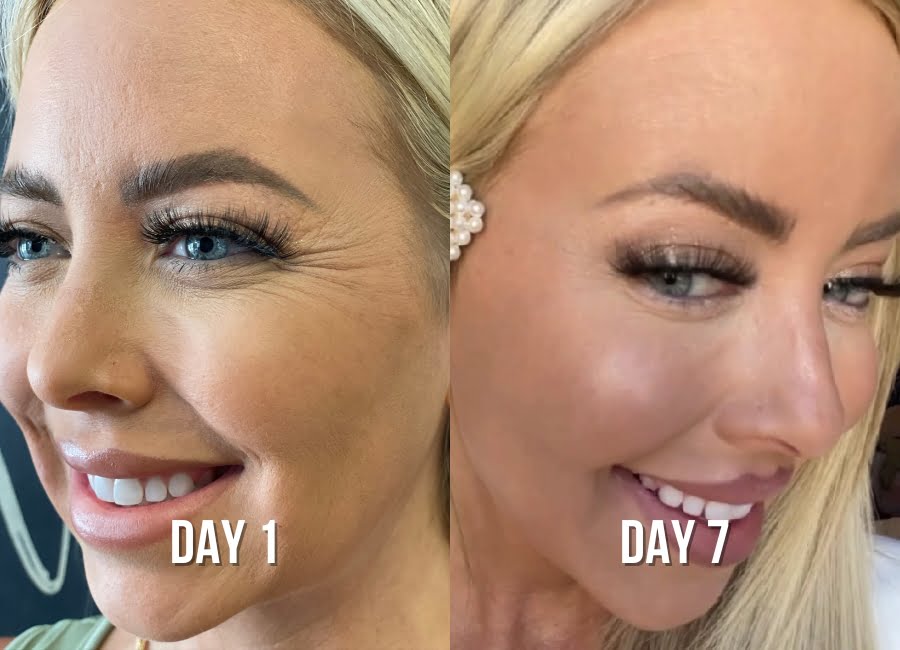 crows-feet-before-after-1-img