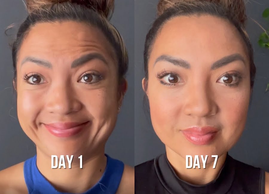 forehead-lines-before-after-2-img