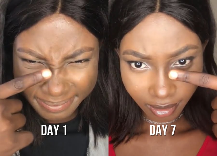 frown-lines-before-after-1-img